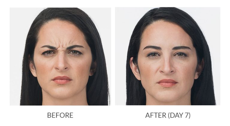 Botox before and after